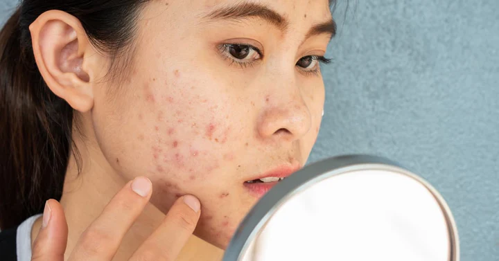 Understanding Erythema in Skincare