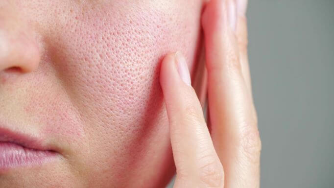 How to Shrink Pores